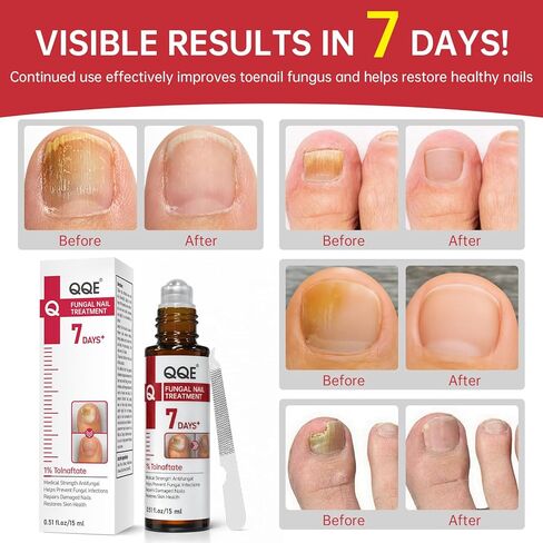 Nail Fungus Treatment Extra Strength – 1% Tolnaftate, Effective Treatment Under and Around Nails, Repairs Damaged Nails, Plant-Based Gentle Formula for Thickened and Discolored Nails, 0.51 fl.oz in Kuwait