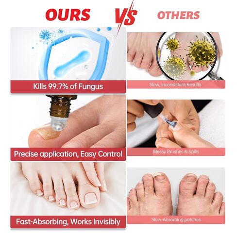 Nail Fungus Treatment Extra Strength – 1% Tolnaftate, Effective Treatment Under and Around Nails, Repairs Damaged Nails, Plant-Based Gentle Formula for Thickened and Discolored Nails, 0.51 fl.oz in Kuwait