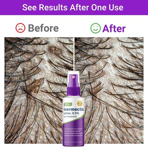 Ivermectin Lotion 0.5%, Formulated for Lice Treatment, No Head Combing Required & Just One Application Will Done, 2 oz in Saudi Arabia