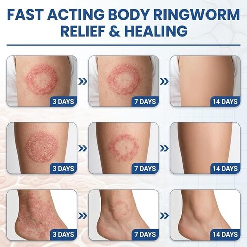 Antifungal Ringworm Treatment Cream, - Miconazole Nitrate 2% Antifungal Cream for Humans - For Fast Itch Relief, Jock Itch & Athlete's Foot - Cream with Ceramides & Tea Tree Oil, Non-Greasy, 3.53oz in Saudi Arabia