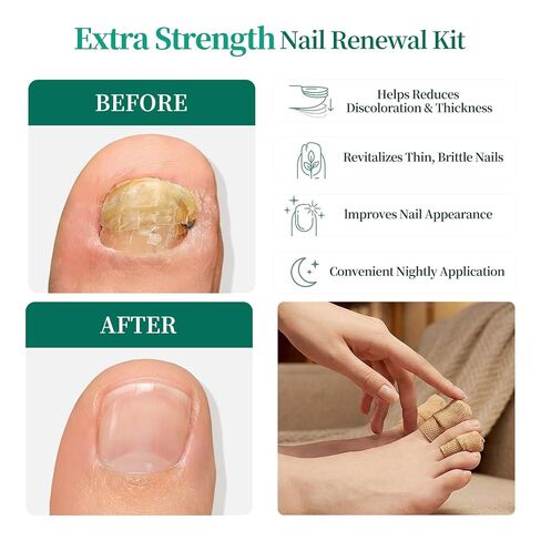 APUREE Fungal Nail Patches Extra Strength: FSA-HSA True 1% Tolnaftate | 8H Overnight Toenail Treatment |Repair For Discolored Yellow Brittle Damage Nails| Restores Healthy Appearance| 64 Patch in Kuwait
