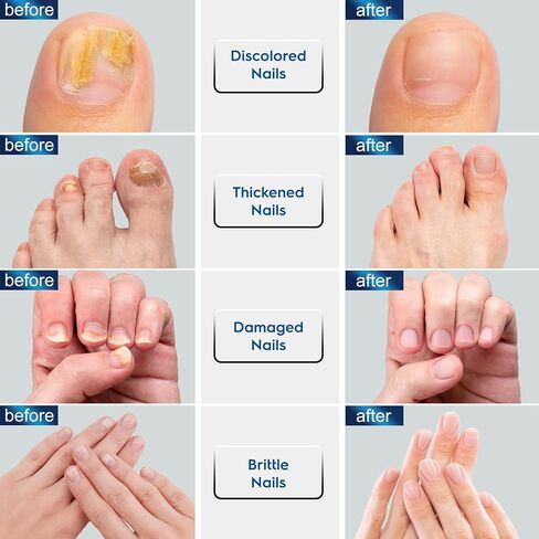 OSIMOON Toenail Fungus Treatment with Undecylenic Acid 10% – Toe Nail Care Solution for Thick & Discolored Nails, Daily Nail Repair Serum for Men & Women (30ml, Ginger) in Saudi Arabia