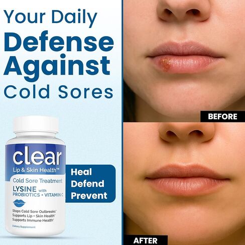 Lysine Cold Sore Treatment for Lips with Pre-Probiotics & VIT C | 1 Month Supply | Supercharged Lysine Capsules with Rhamnosus & Acidophilus for Cold Sores Relief, Skin + Gut Health & Immune Support in Saudi Arabia