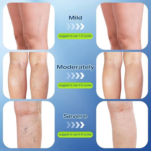 Vein Ease Microdarts Care Patches 2 Hours Fast Acting Leg Vein Care Patch Soothe Leg Swelling & Fatigue Improve Blood Circulation Varicose Veins Relief Patch for All Men Women All Skin Types in Saudi Arabia