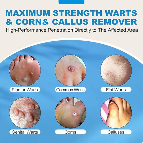 Wart Remover Maximum Strength - Wart Liquid with Salicylic Acid - Fast-Acting Wart Freeze Off Designed for Warts, Plantar Wart, Genital Wart, Common Wart, Flat Wart, Corn, Callus in Saudi Arabia