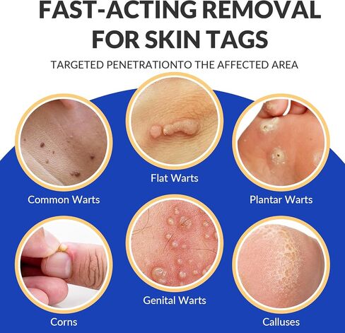 Wart & Corn Remover Gel - 20% Salicylic Acid + Bee Venom | Treats Flat/Common Warts, Plantar Warts & Foot Corns | Gentle Precision Tube Formula 0.5 oz in Saudi Arabia