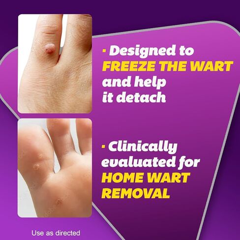 Silka Pointts Wart Remover Freeze Off, At-Home Cryotherapy Freezer for Common and Plantar Warts on Hands and Feet, Designed for Safe and Easy Wart Removal with 12 Precision Applicators in Saudi Arabia
