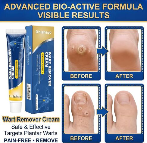 wart Remover Freeze Off,with Salicylic Acid 17% - Fast-Acting Gel for Common & Plantar Warts on Hands and Feet, Maximum Strength - 20G/0.7OZ in Saudi Arabia