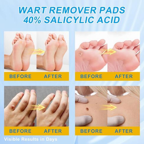 WART Corn Remover Pads for Feet 40% Salicylic Acid Wart Remover Pads, WART Corn Removers for Toes,Body（NDC Code: 85248-065-01） in Saudi Arabia