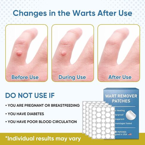Wart Remover Patches with 40% Max Strength Salicylic Acid, Hydrocolloid Adhesive Patches for Common & Plantar Warts, Skin Bump Care – Waterproof for Feet & Fingers,144 Patches in Saudi Arabia
