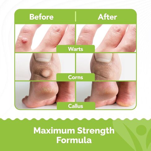 Samsali Liquid Plantar Wart Remover: 20ml Salicylic Acid Liquid for The Removal of Plantar Flat Warts Corns Calluses on Feet Toes and Hands - Safe for Teens Adults Seniors Men and Women in Saudi Arabia