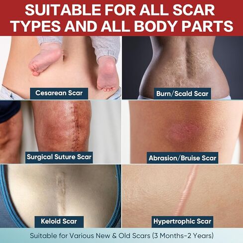 Silicone Scar Tape (1.6"x240"-6M),Silicone Scar Sheets for Scar Removal Treatment,Silicone Scar Removal Strips for Surgical,C-Section,Tummy Tuck,Keloid Scars in Kuwait