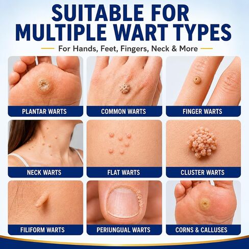 DVO Wart Remover, 20% Salicylic Acid Wart Remover Liquid – Fast Acting Wart Treatment with Precision Brush Applicator, Wart Remover for Hands, Feet & Body 15ml in Saudi Arabia