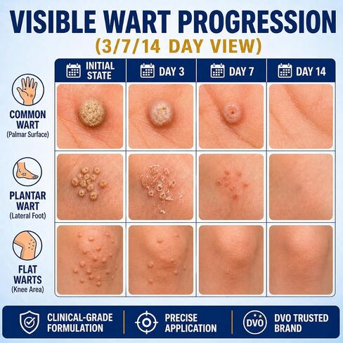 DVO Wart Remover, 20% Salicylic Acid Wart Remover Liquid – Fast Acting Wart Treatment with Precision Brush Applicator, Wart Remover for Hands, Feet & Body 15ml in Saudi Arabia