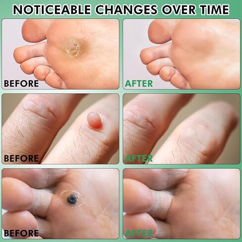 Wart Remover with 15% Salicylic Acid, Maximum Strength Skin Tag Remover for Common and Plantar Warts, Corns & Calluses, Fast-Acting Skin Tag Removal for Men and Women in Kuwait