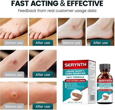 Wart Remover Liquid Maximum Strength - 17% Salicylic Acid, Fast-Acting, Effective & Painless Wart Removal for Plantar, Common & Flat Warts, Most Body Warts 30ML in Saudi Arabia