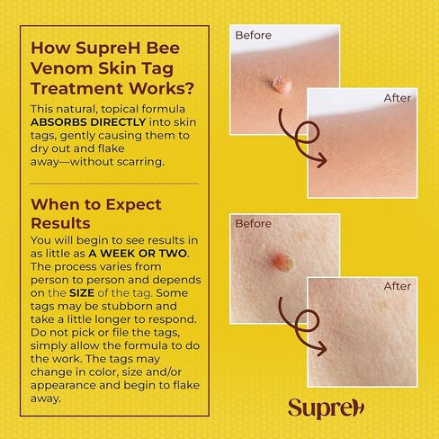 SupreH Fast-Acting Bee Venom Wart Skin Tag Remover for Men and Women 20 M in Kuwait