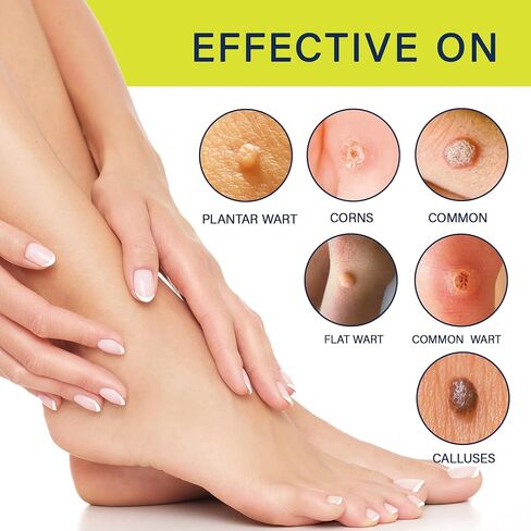 Fast-Acting Wart Remover Freeze Off with Salicylic Acid Maximum Strength for Men and Women - Plantar Wart Genital Wart Corns Calluses 1 oz in Saudi Arabia