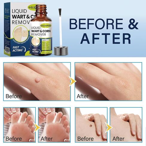 Fast-Acting Wart Remover Freeze Off with Salicylic Acid Maximum Strength for Men and Women - Plantar Wart Genital Wart Corns Calluses 1 oz in Saudi Arabia