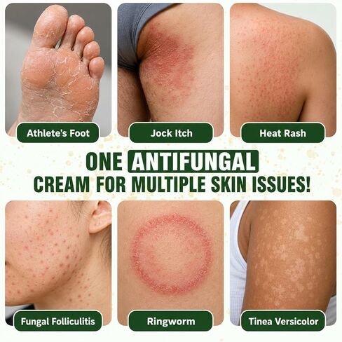 Antifungal Cream with Tea Tree Oil - Advanced Herbal Relief for Skin Fungus, Athlete's Foot, Jock Itch, Eczema, Tinea Versicolor, Natural Treatment, Relieves Itching, Burning, Scaling - 100g in Saudi Arabia