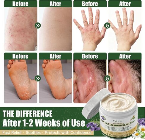 Antifungal Cream with Tea Tree Oil - Advanced Herbal Relief for Skin Fungus, Athlete's Foot, Jock Itch, Eczema, Tinea Versicolor, Natural Treatment, Relieves Itching, Burning, Scaling - 100g in Saudi Arabia