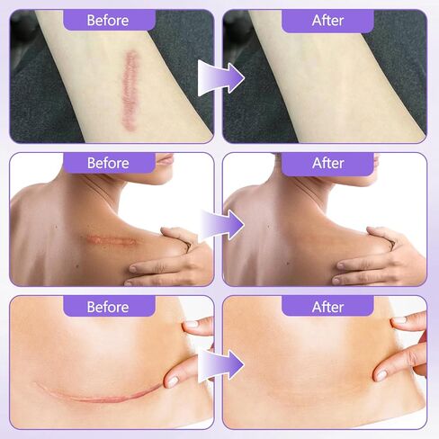 Collagen Tape, Collagen Sheets for Scars & Wrinkle, Silicone Scar Removal Strips for Various Different Scars and Wrinkles, for Surgeries Burn Acne Wounds Recovery in Saudi Arabia