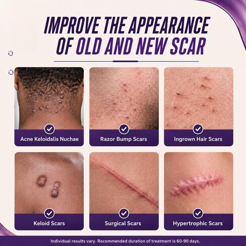 ABERA Kelo Scar Cream – Scar Removal Cream for AKN Bump Treatment, Razor Bump Treatment for Men & Keloid Bump Removal with Purple Onion & Black Reishi in Saudi Arabia