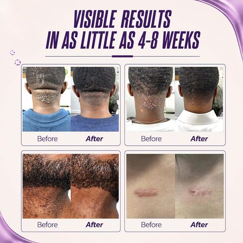 ABERA Kelo Scar Cream – Scar Removal Cream for AKN Bump Treatment, Razor Bump Treatment for Men & Keloid Bump Removal with Purple Onion & Black Reishi in Saudi Arabia