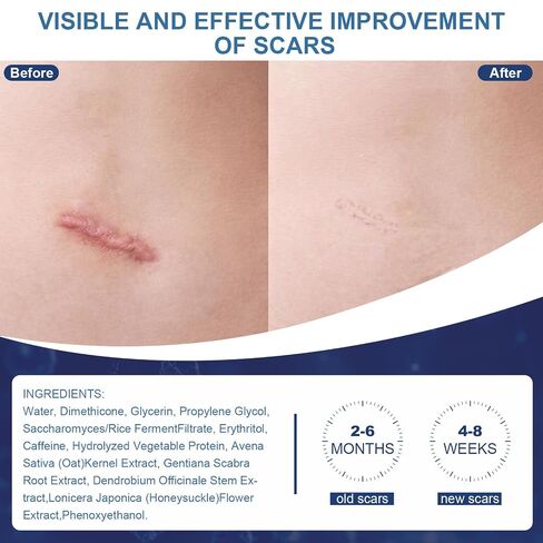 Scar Cream,Silicone Scar Gel,Helps Reduce Surgical Scars,Acne,Burn,Keloids Bump,Stretch Marks, Advanced Scar Removal Cream for Old and New Scars(1.69oz) in Saudi Arabia