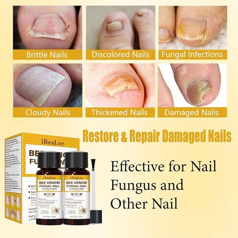 Toenail Fungus Treatment Extra Strength, Bee Venom Nail Fungus Treatments with 25% Undecylenic Acid, Tea Tree Oil Nail Repair for Yellow, Thick, Damaged, Discolored Toe Nail & Fingernails-Y02 in Saudi Arabia