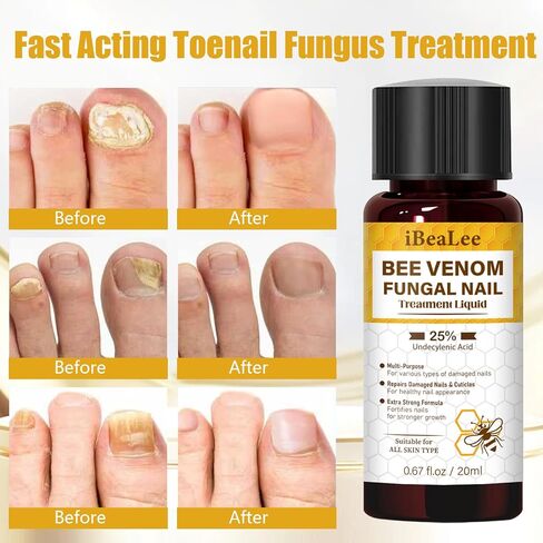 Toenail Fungus Treatment Extra Strength, Bee Venom Nail Fungus Treatments with 25% Undecylenic Acid, Tea Tree Oil Nail Repair for Yellow, Thick, Damaged, Discolored Toe Nail & Fingernails-Y02 in Saudi Arabia