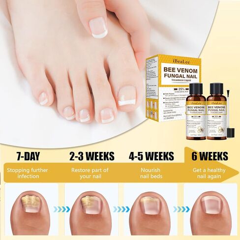 Toenail Fungus Treatment Extra Strength, Bee Venom Nail Fungus Treatments with 25% Undecylenic Acid, Tea Tree Oil Nail Repair for Yellow, Thick, Damaged, Discolored Toe Nail & Fingernails-Y02 in Saudi Arabia