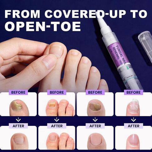 Nail Fungus Pen-Extra Strength Nail Fungus Treatment with 25% Undecylenic Acid & Tea Tree Oil for Toenails & Fingernails in Kuwait