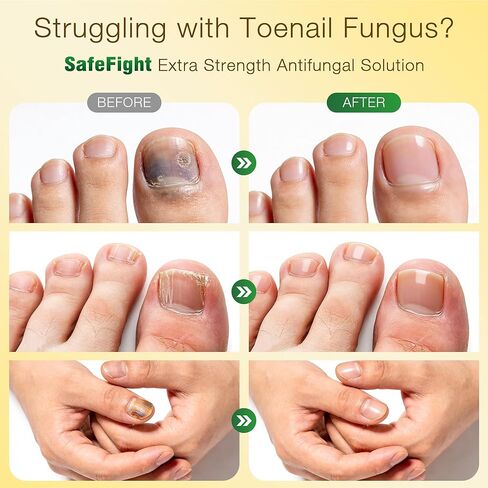 Toenail Fungus Treatment with 25% Undecylenic Acid & Tolnaftate, SafeFight Nail Repair Solution for Fungi Nail, Toenail Fungus Treatment Extra Strength Nail Repair for Fungi Nail in Saudi Arabia