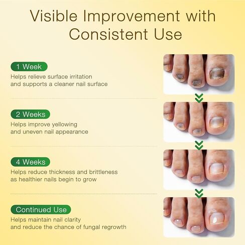 Toenail Fungus Treatment with 25% Undecylenic Acid & Tolnaftate, SafeFight Nail Repair Solution for Fungi Nail, Toenail Fungus Treatment Extra Strength Nail Repair for Fungi Nail in Saudi Arabia