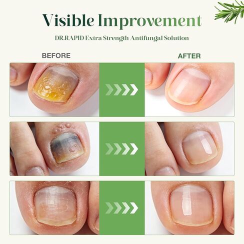 Toenail Fungus Treatment Extra Strength - DR.RAPID Nail Repair for Damaged Nails, Nail Fungus Treatment Extra Strength with 25% Undecylenic Acid & Tea Tree Oil, Nail Repair for nail fungus treatment in Kuwait