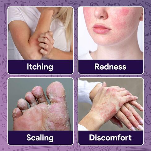 FifthPulse Miconazole Antifungal Cream, 1oz - Anti Fungal Cream for Skin that Aids with Redness, Scaling, Itching, Discomfort, and More - for Athletes Foot, Ringworm, and Jock Itch in Kuwait