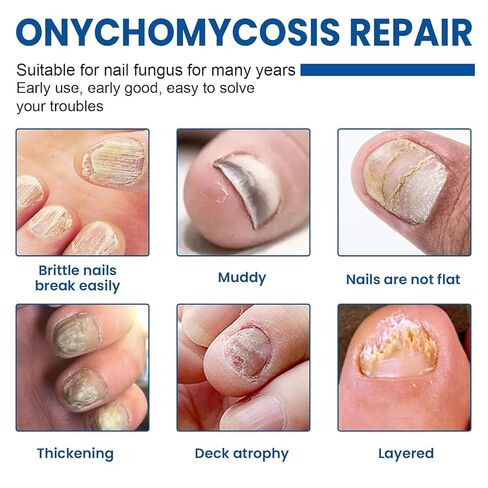 Toenail Fungus Treatment Extra Strength, 60Pcs Fungal Nail Patches for Damaged Nails, 8-Hour Nighttime Renewal & Natural Hydrogel Nail Repair Patches in Kuwait