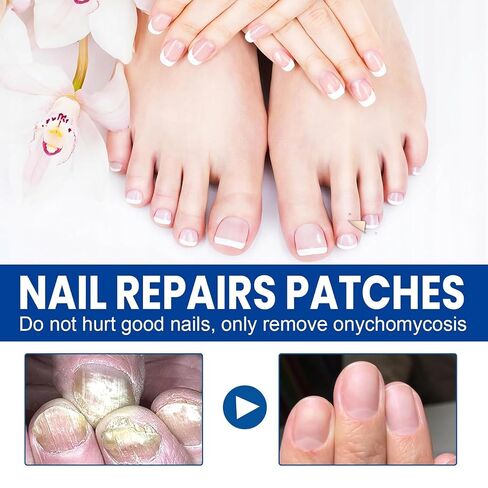 Toenail Fungus Treatment Extra Strength, 60Pcs Fungal Nail Patches for Damaged Nails, 8-Hour Nighttime Renewal & Natural Hydrogel Nail Repair Patches in Kuwait