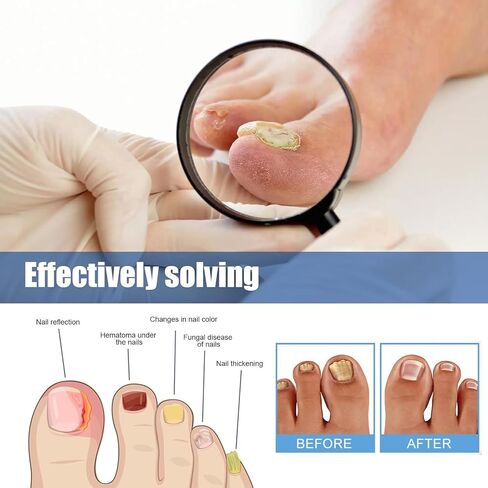 Toenail Fungus Treatment Extra Strength, 60Pcs Fungal Nail Patches for Damaged Nails, 8-Hour Nighttime Renewal & Natural Hydrogel Nail Repair Patches in Kuwait