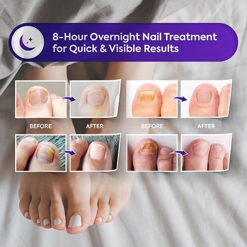 Toenail Fungus Treatment Extra Strength: Nail Fungus Treatment Patches for Toenail and Fingernails - 8-Hour Nighttime Renewal with 1% Tolnaftate - 32 Patches in Saudi Arabia