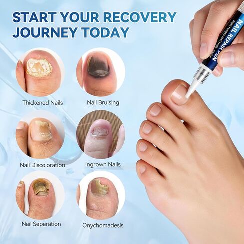 Nail Fungus Treatment Pen (5 Count) 25% Undecylenic Acid Maximum Strength Toenail Fungus Pen, Suitable for Toenail Repair for Damaged, Broken& Discolored Nails Repair -5ml/0.18FLOZ in Kuwait