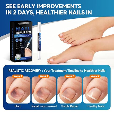 Nail Fungus Treatment Pen (5 Count) 25% Undecylenic Acid Maximum Strength Toenail Fungus Pen, Suitable for Toenail Repair for Damaged, Broken& Discolored Nails Repair -5ml/0.18FLOZ in Kuwait