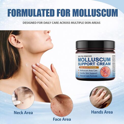 Molluscum Support Treatment, Molluscum Support Cream All Natural Support Cream for Molluscum Rash, 30g in Kuwait