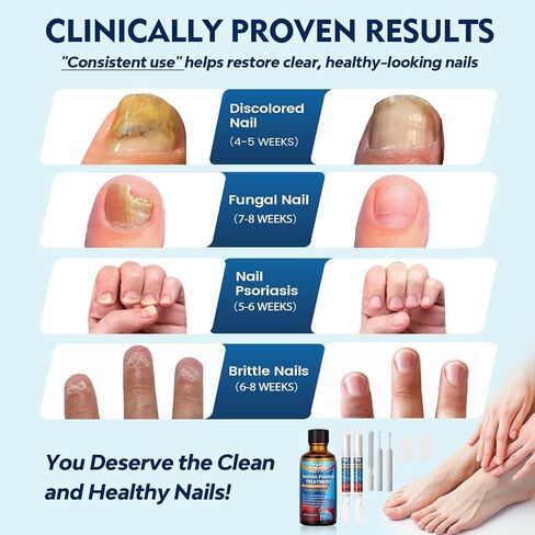 Toenail Fungus Treatment Extra Strength, Nail Fungus Treatment for Thick, Discolored Fungi Nails - 25% Undecylenic Acid All-in-One Kit with 30ML Fungi Nail Solution, 2 Nail Repair Pens in Saudi Arabia