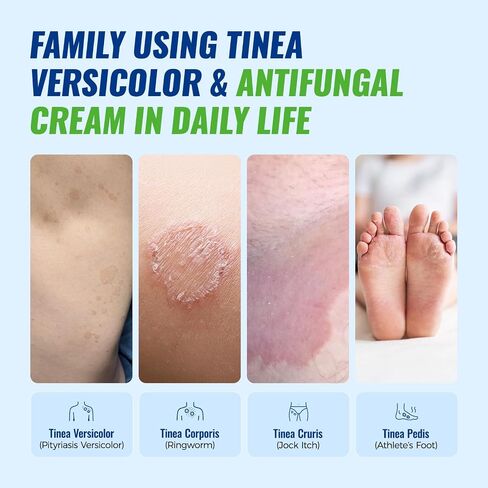 CHARMPOO Clotrimazole 1% Antifungal Cream for Tinea Versicolor, 3.53 oz | Ringworm and jock itch care; tea tree, myrrh, ceramides and glycerin; fast-absorbing for chest, back, neck. in Saudi Arabia