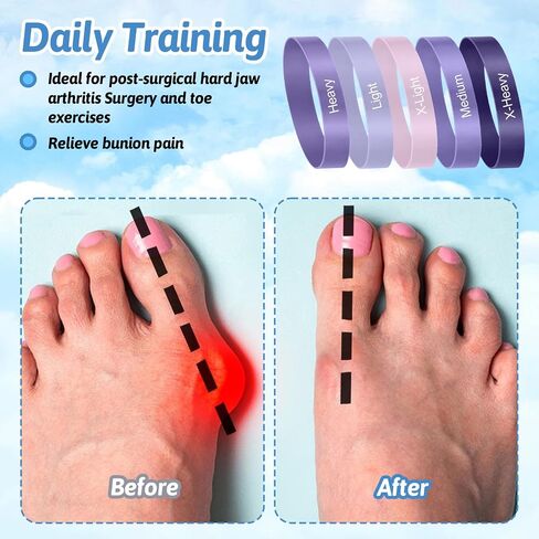 5Pcs Toe Stretcher Bands for Bunions, Toe Bands Resistance for Women and Men with Storage Bag(Purple) in Kuwait