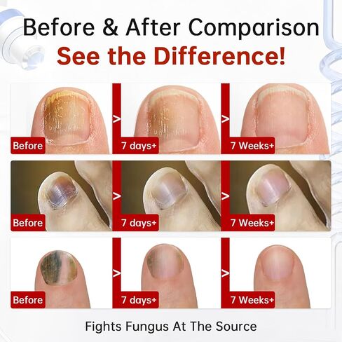 Toenail Fungus Treatment Extra Strength, 1% Tolnaftate Antifungal Fungal Nail Treatment, ToeNail Fungus Treatments For Thick Discolored Brittle Crumbling Nails, 0.51 fl oz (Pack of 1) in Saudi Arabia