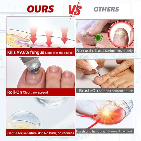Toenail Fungus Treatment Extra Strength, 1% Tolnaftate Antifungal Fungal Nail Treatment, ToeNail Fungus Treatments For Thick Discolored Brittle Crumbling Nails, 0.51 fl oz (Pack of 1) in Saudi Arabia