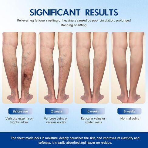 VeinTarget Microdarts Patch - Improves the Appearanceof Leg, 2026 New Leg Renew Varicose Veins Patch,VeinTarget Patches for Legs Care - All Skin Types (2 Boxes) in Saudi Arabia